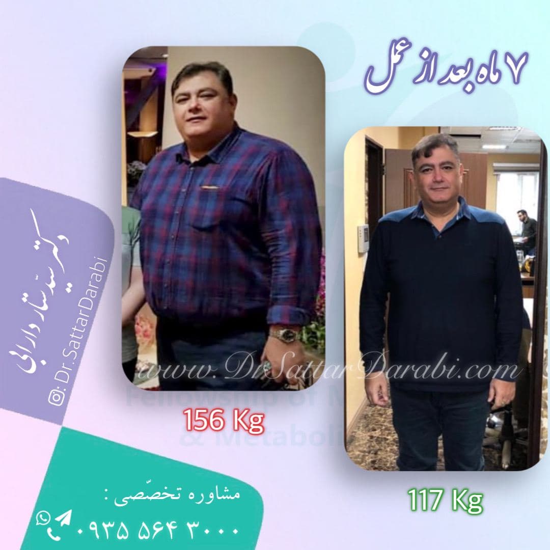 Weight loss surgery before and after case 7 published by Dr Sattar Darabi