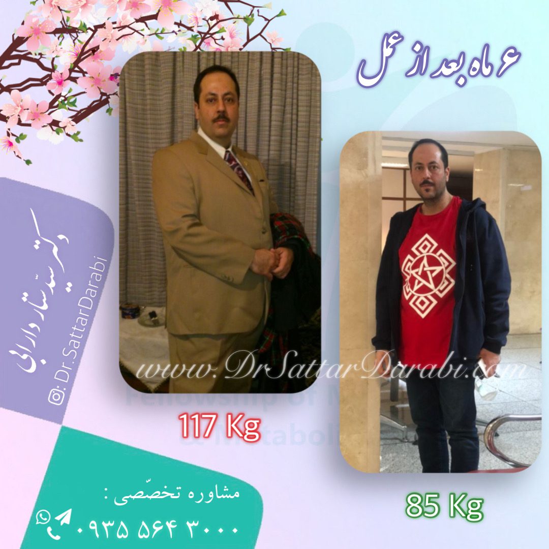 Weight loss surgery before and after case 8 published by Dr Sattar Darabi