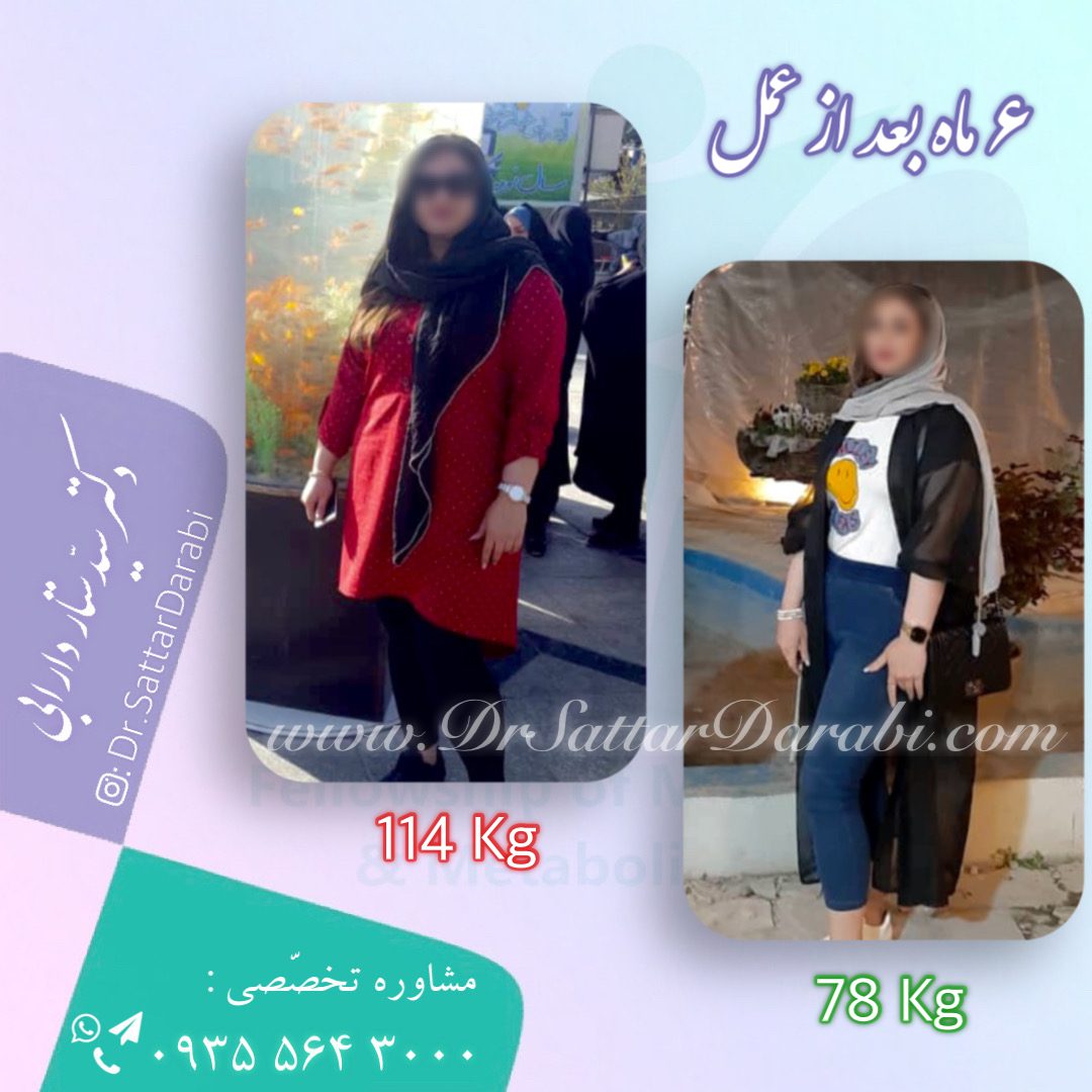Weight loss surgery before and after case 9 published by Dr Sattar Darabi