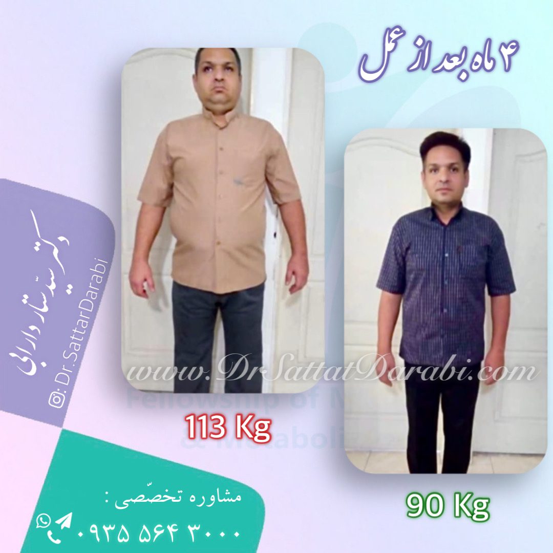 Weight loss surgery before and after case 11 published by Dr Sattar Darabi