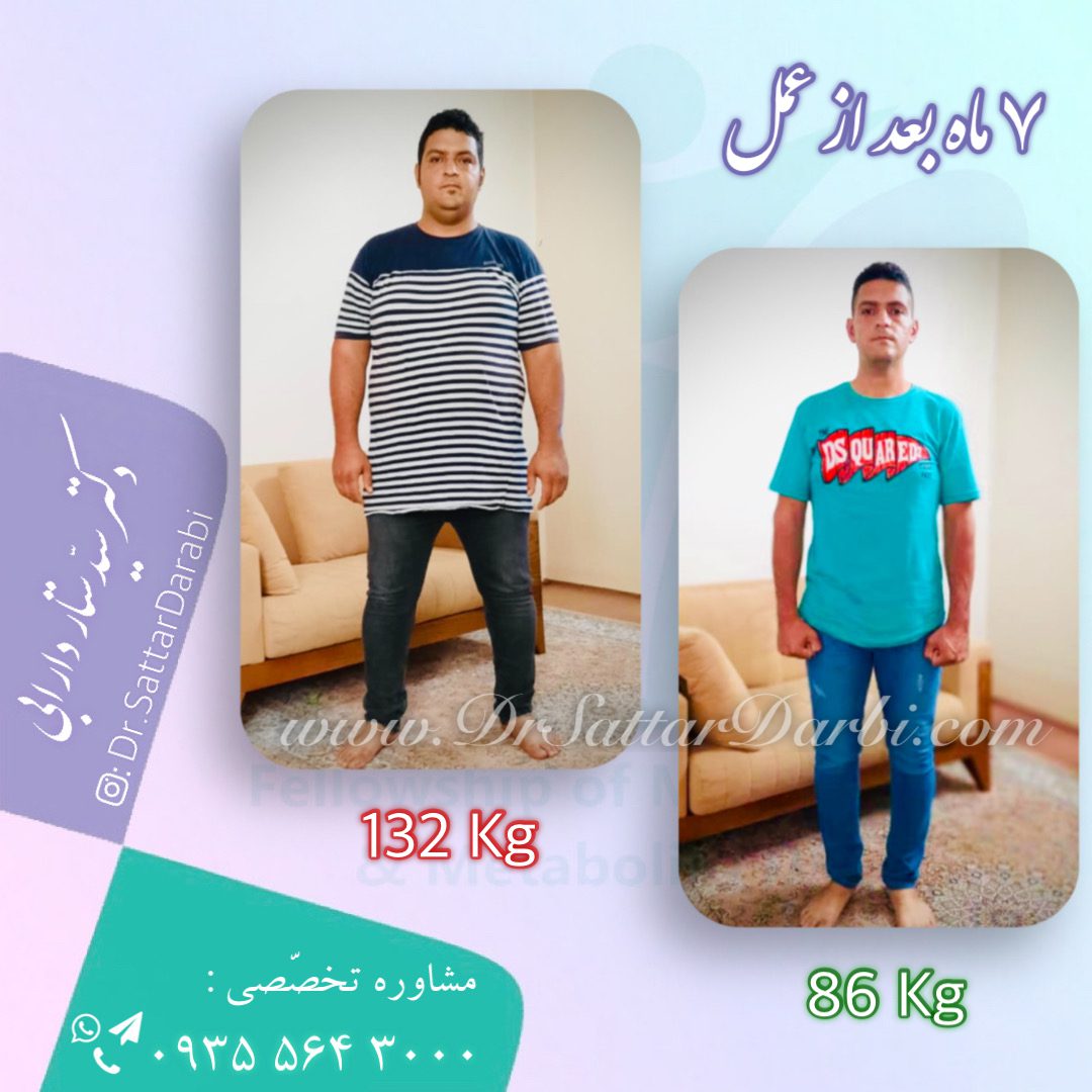 Weight loss surgery before and after case 12 published by Dr Sattar Darabi