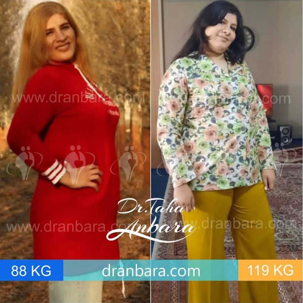 Weight loss surgery before and after case 15 published by Dr Taha Anbara
