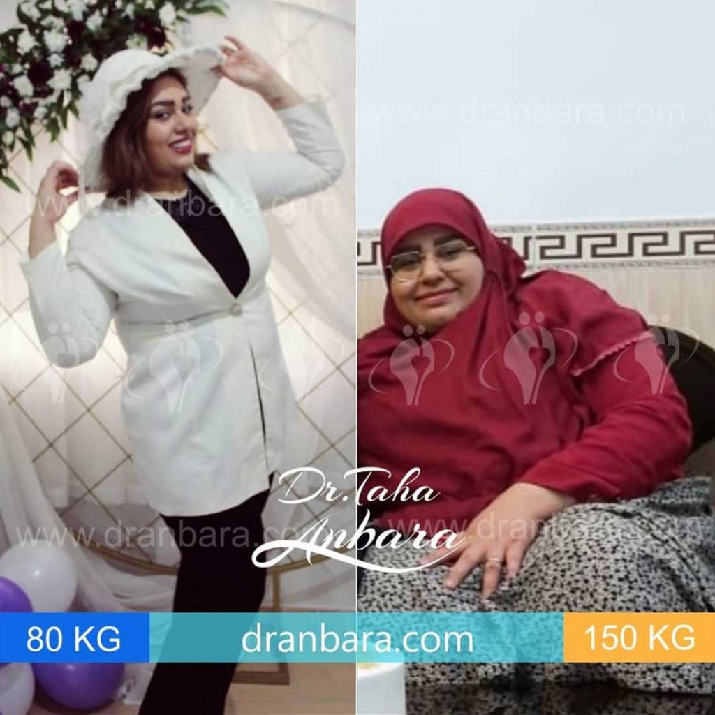Weight loss surgery before and after case 16 published by Dr Taha Anbara