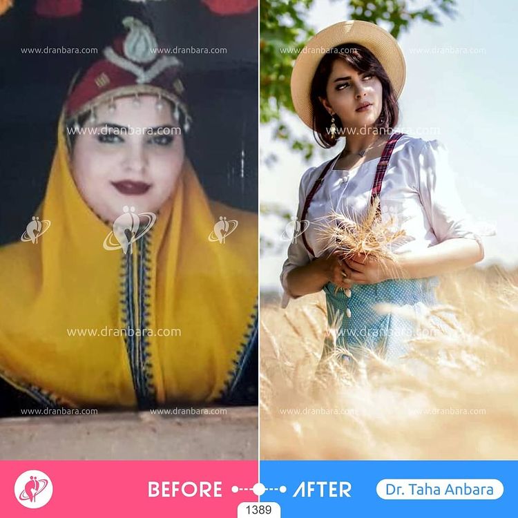 Weight loss surgery before and after case 17 published by Dr Taha Anbara