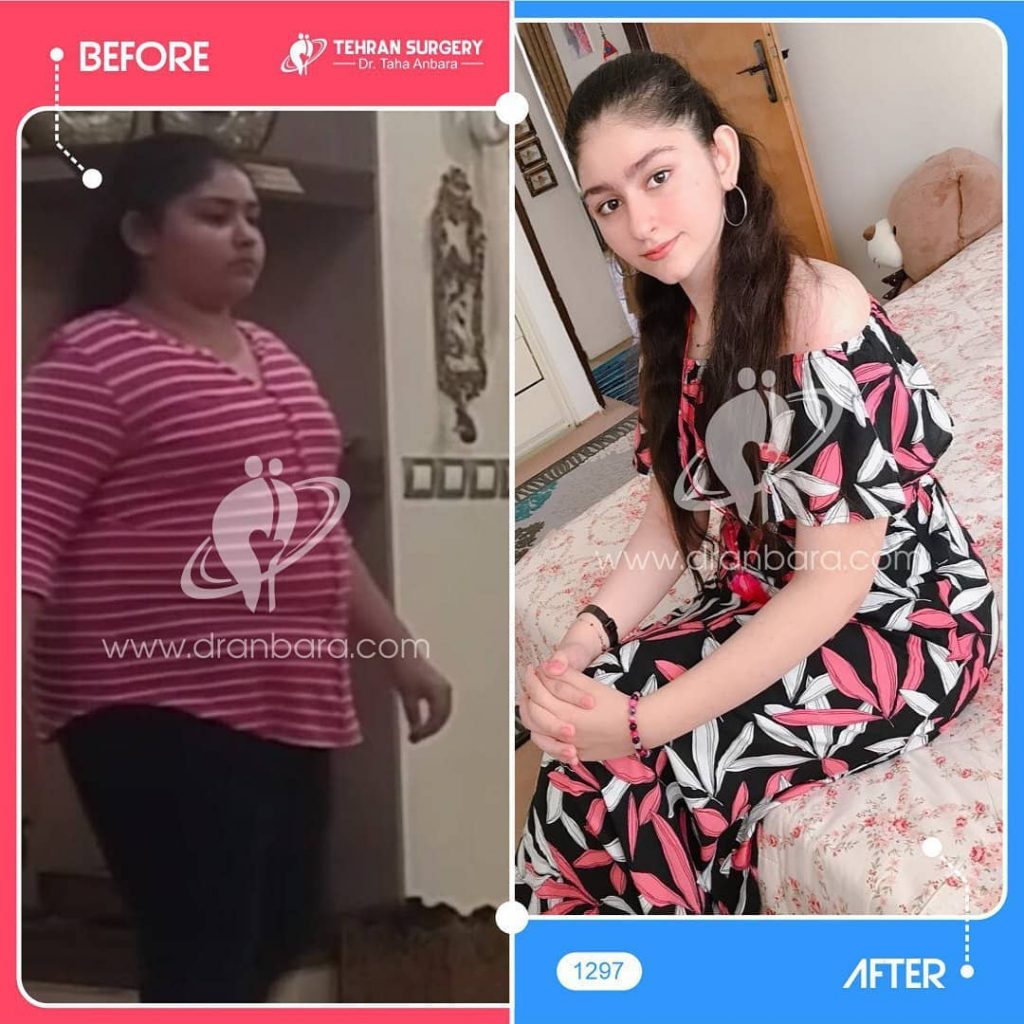 Weight loss surgery before and after case 18 published by Dr Taha Anbara