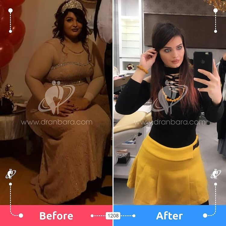 Weight loss surgery before and after case 19 published by Dr Taha Anbara