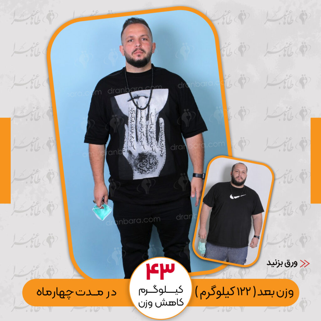 Weight loss surgery before and after case 21 published by Dr Taha Anbara