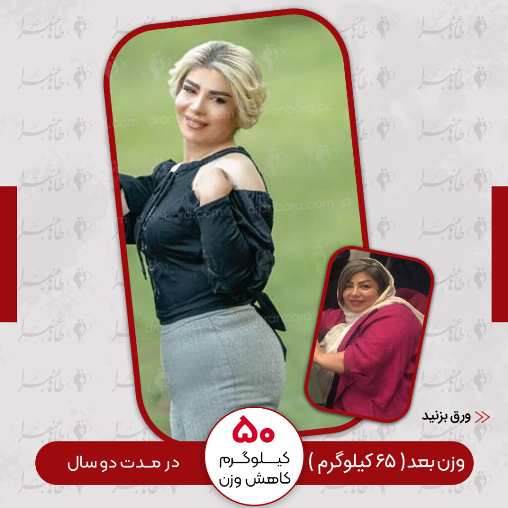 Weight loss surgery before and after case 22 published by Dr Taha Anbara