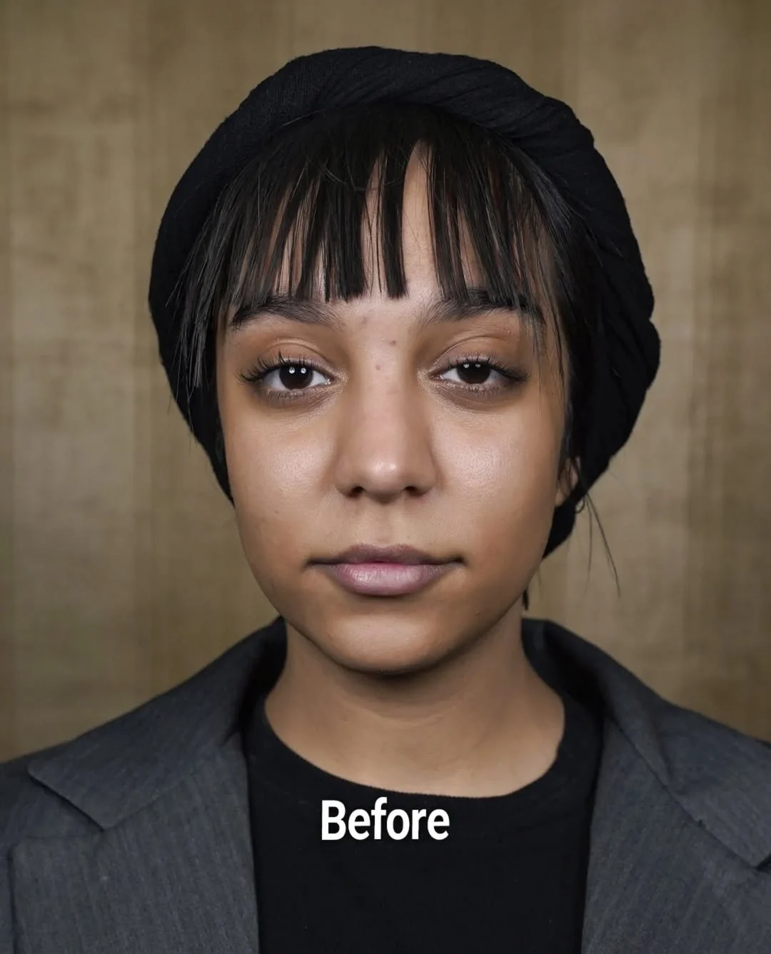 Facial contouring, before, published example 1 from Baran Clinic, Tehran