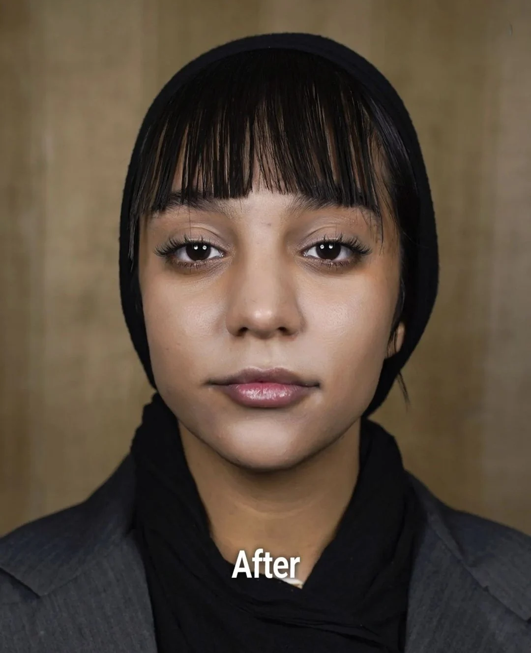 Facial contouring, after, published example 2 from Baran Clinic, Tehran