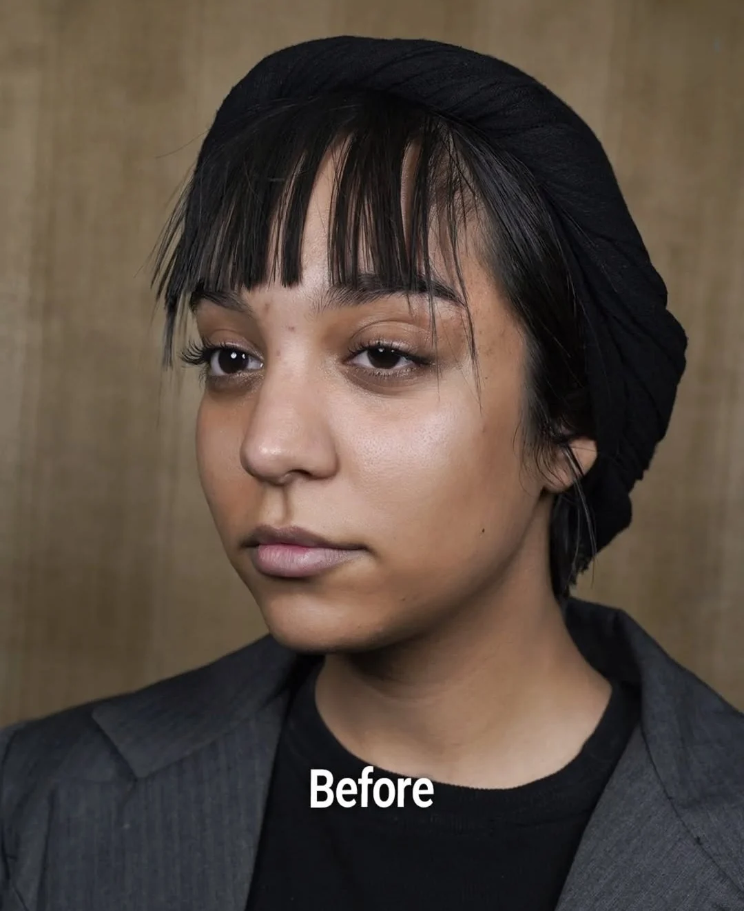 Facial contouring, before, published example 3 from Baran Clinic, Tehran