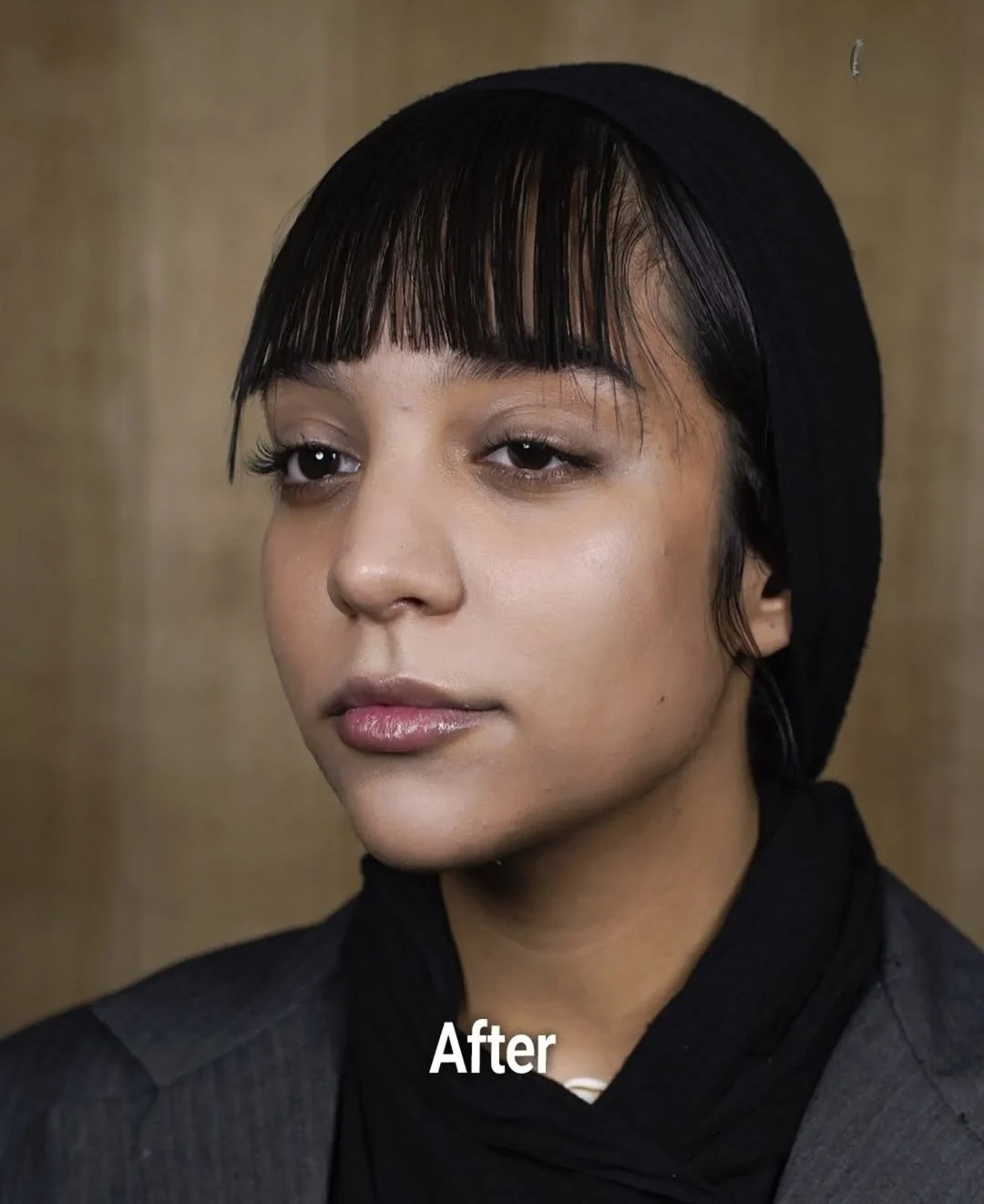 Facial contouring, after, published example 4 from Baran Clinic, Tehran