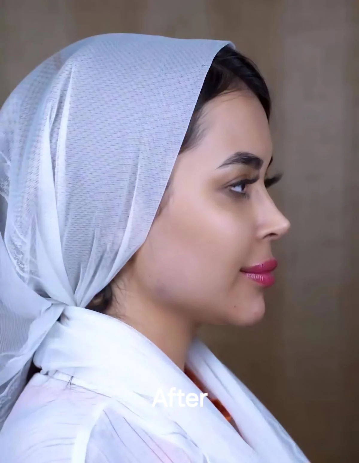 Lip filler, after, published example 6 from Baran Clinic, Tehran