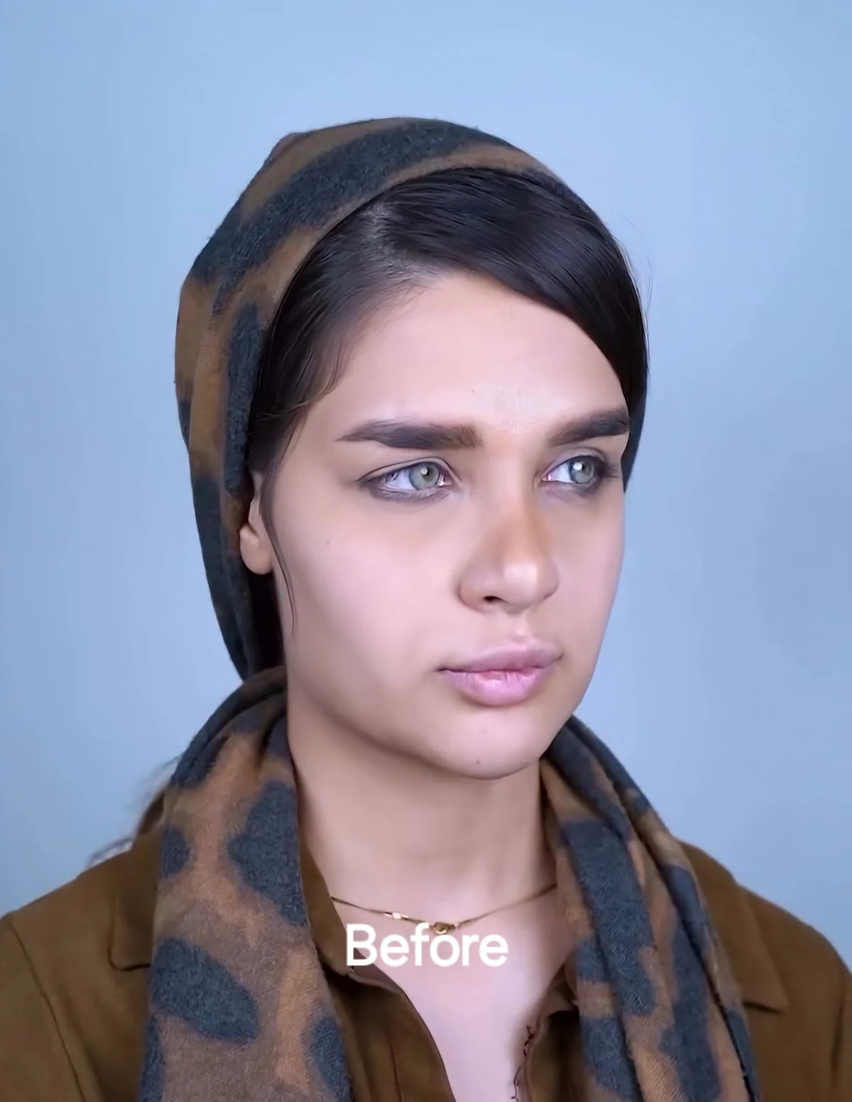 Lip filler, before, published example 7 from Baran Clinic, Tehran