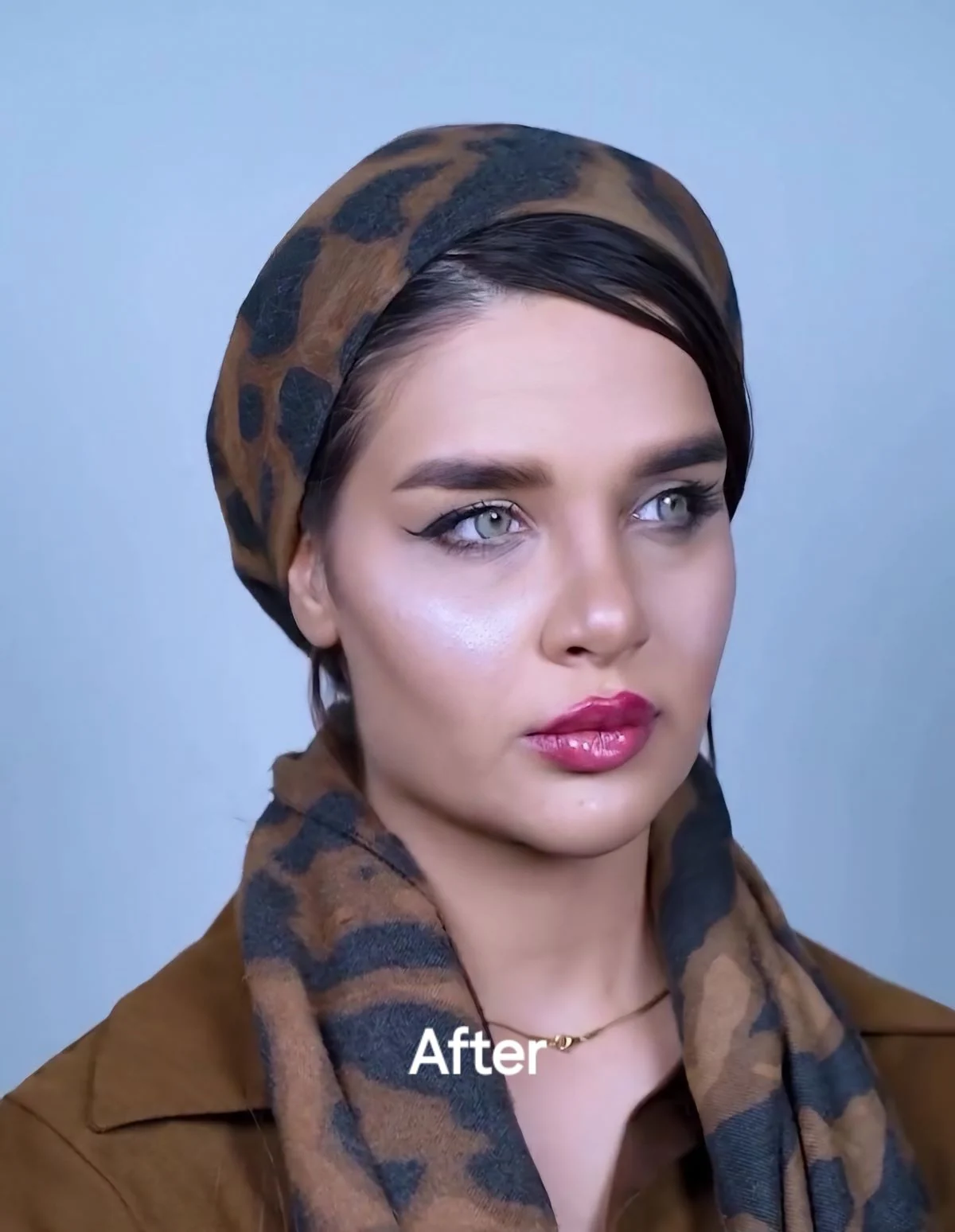 Lip filler, after, published example 8 from Baran Clinic, Tehran