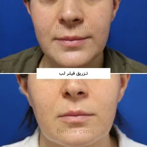 Provider-published aesthetic comparison, published example 1 from Behdis Clinic, Tehran