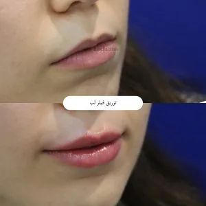 Provider-published aesthetic comparison, published example 3 from Behdis Clinic, Tehran