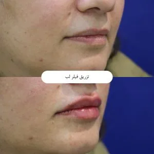 Provider-published aesthetic comparison, published example 5 from Behdis Clinic, Tehran