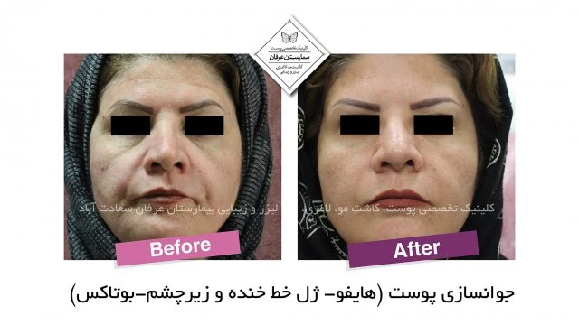Provider-published gel-injection comparison, published example 1 from Erfan Hospital Laser & Skin Clinic, Tehran