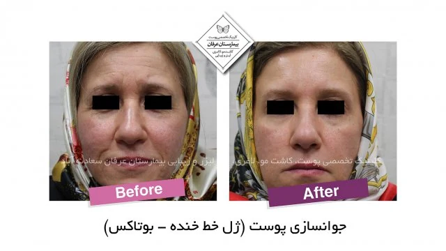 Provider-published gel-injection comparison, published example 2 from Erfan Hospital Laser & Skin Clinic, Tehran