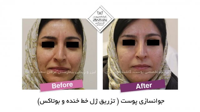 Provider-published gel-injection comparison, published example 3 from Erfan Hospital Laser & Skin Clinic, Tehran