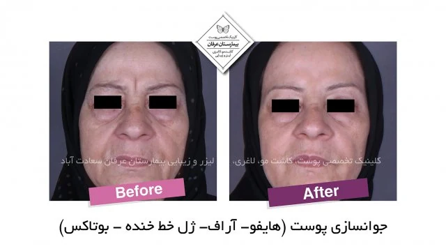 Provider-published gel-injection comparison, published example 4 from Erfan Hospital Laser & Skin Clinic, Tehran