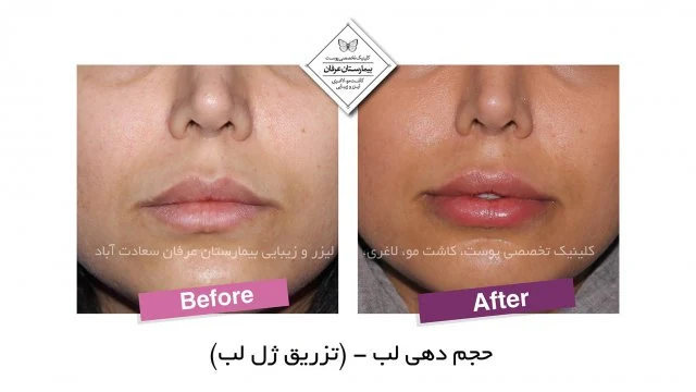 Provider-published gel-injection comparison, published example 5 from Erfan Hospital Laser & Skin Clinic, Tehran