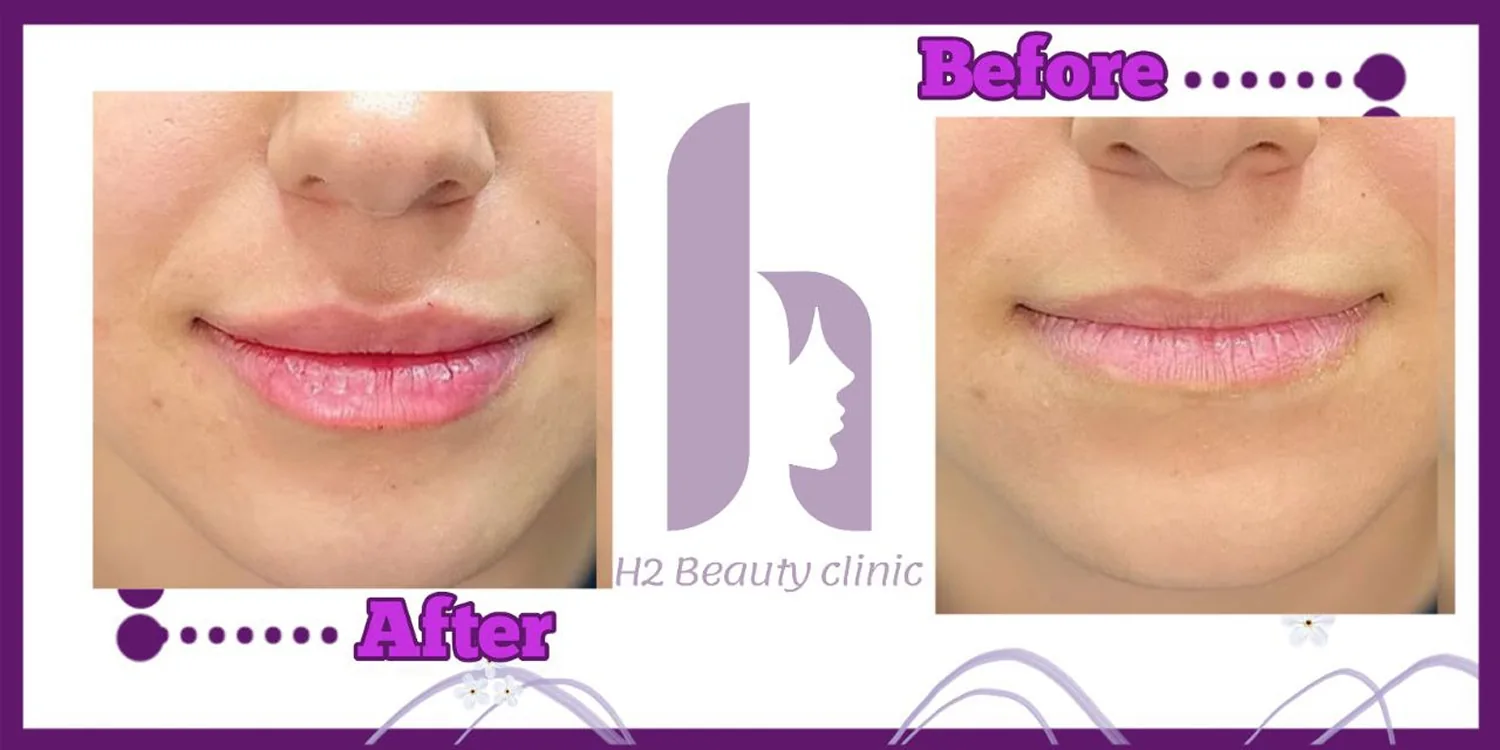 Provider-published lip filler comparison from H2 Clinic in Tehran, used to illustrate source-checking