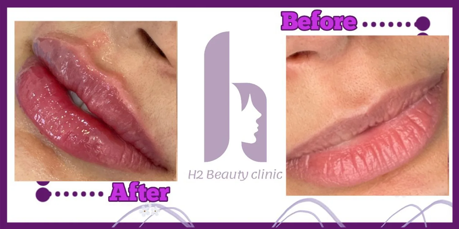 Lip filler, published example 2 from H2 Clinic, Tehran