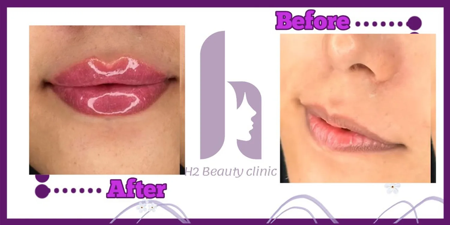 Lip filler, published example 3 from H2 Clinic, Tehran