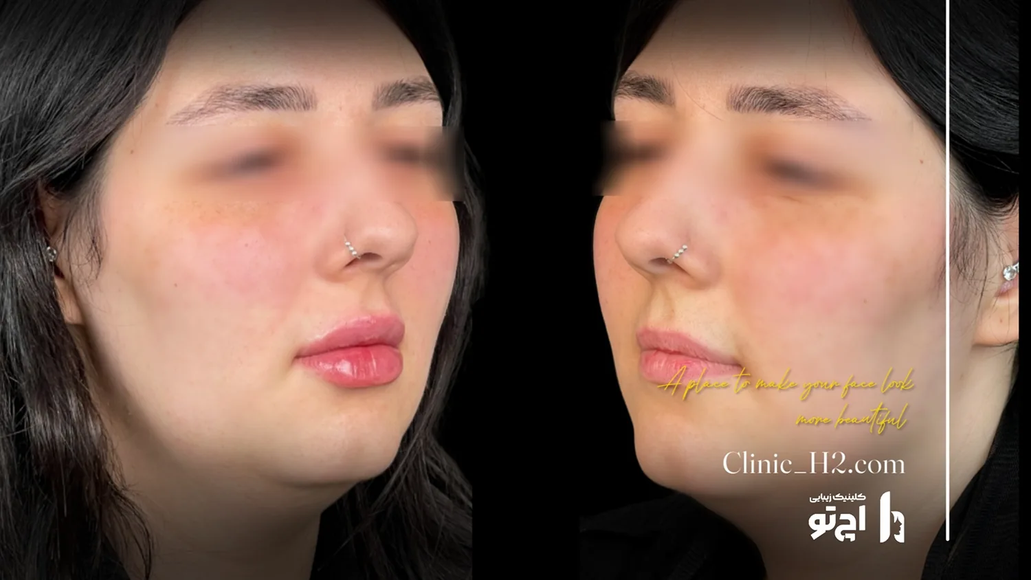 Lip filler, published example 5 from H2 Clinic, Tehran