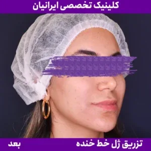 Smile-line filler, published example 2 from Iranian Clinic, Zaferanieh branch, Tehran