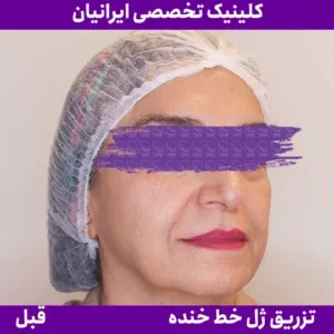Smile-line filler, published example 3 from Iranian Clinic, Zaferanieh branch, Tehran