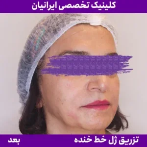 Smile-line filler, published example 5 from Iranian Clinic, Zaferanieh branch, Tehran