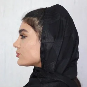 Jawline or chin filler, published example 5 from Landa Clinic, Tehran branch, Tehran
