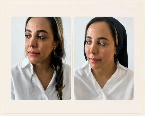 Provider-published aesthetic comparison, published example 2 from Lemon Clinic, Tehran