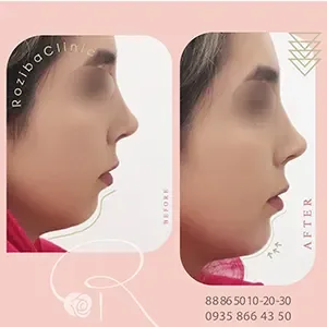 Chin or facial filler, published example 1 from Roziba Clinic, Tehran