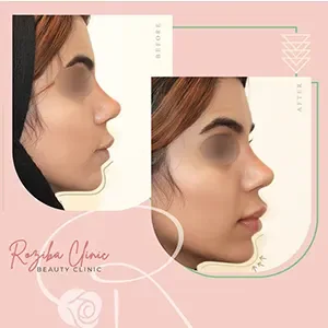 Chin or facial filler, published example 2 from Roziba Clinic, Tehran