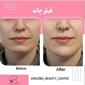 Chin or facial filler, published example 3 from Roziba Clinic, Tehran