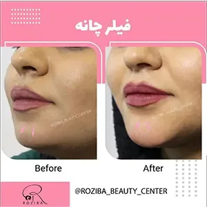 Chin or facial filler, published example 4 from Roziba Clinic, Tehran