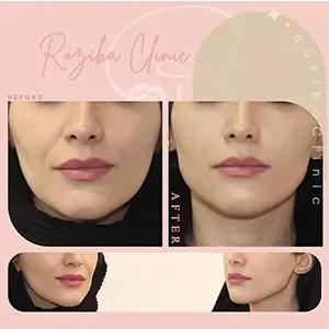 Chin or facial filler, published example 5 from Roziba Clinic, Tehran