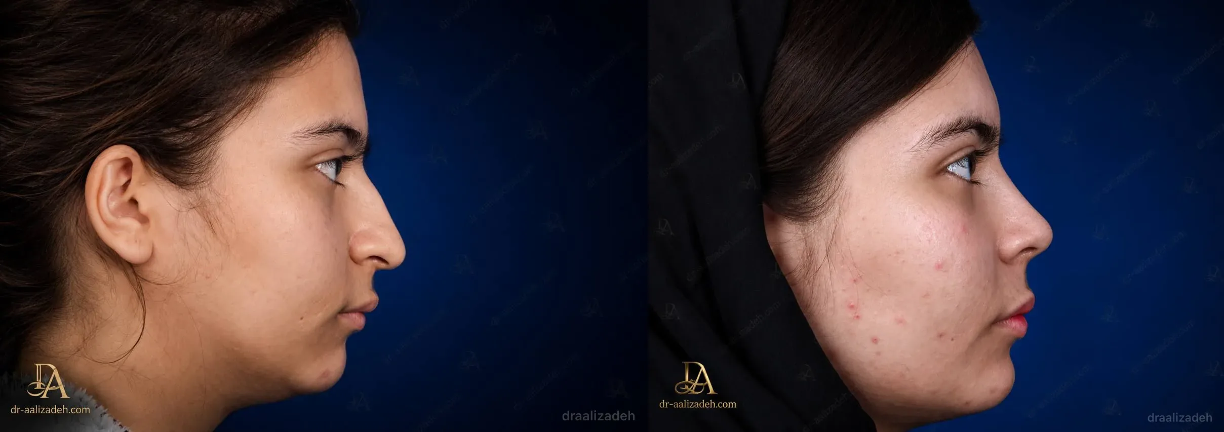 Provider-published rhinoplasty comparison image 1 from Dr. Ali Alizadeh