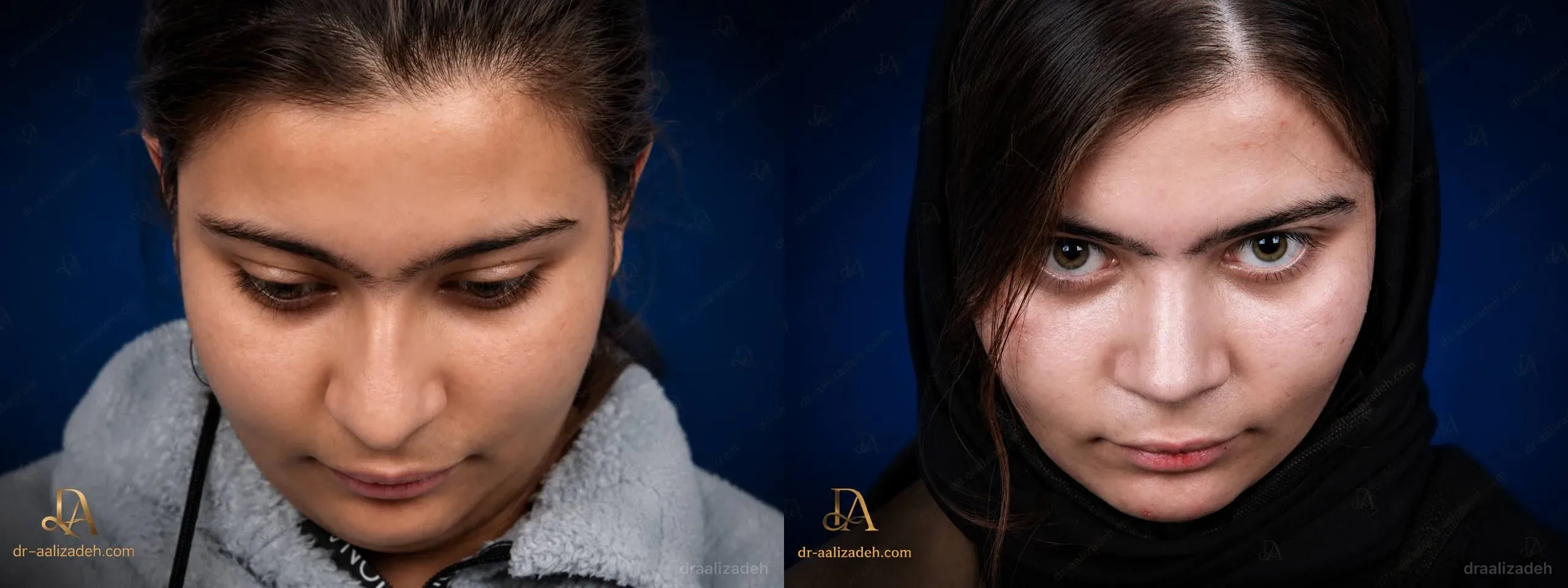 Provider-published rhinoplasty comparison image 2 from Dr. Ali Alizadeh