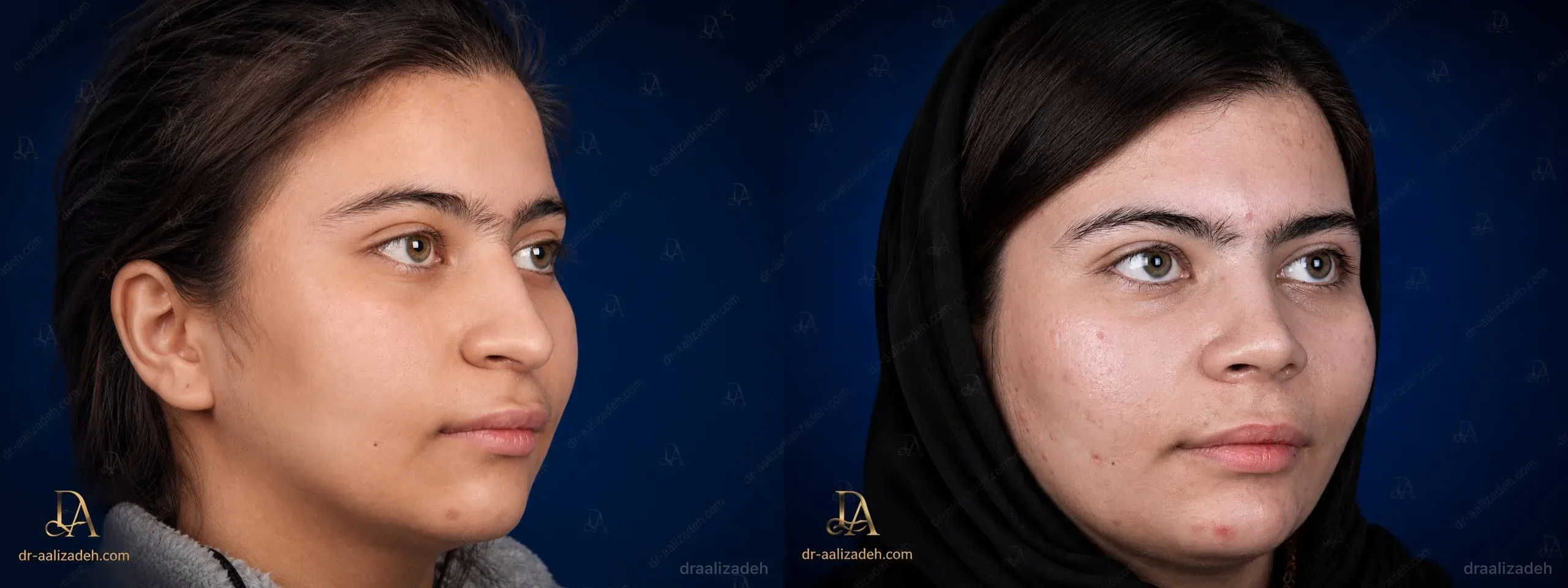 Provider-published rhinoplasty comparison image 3 from Dr. Ali Alizadeh