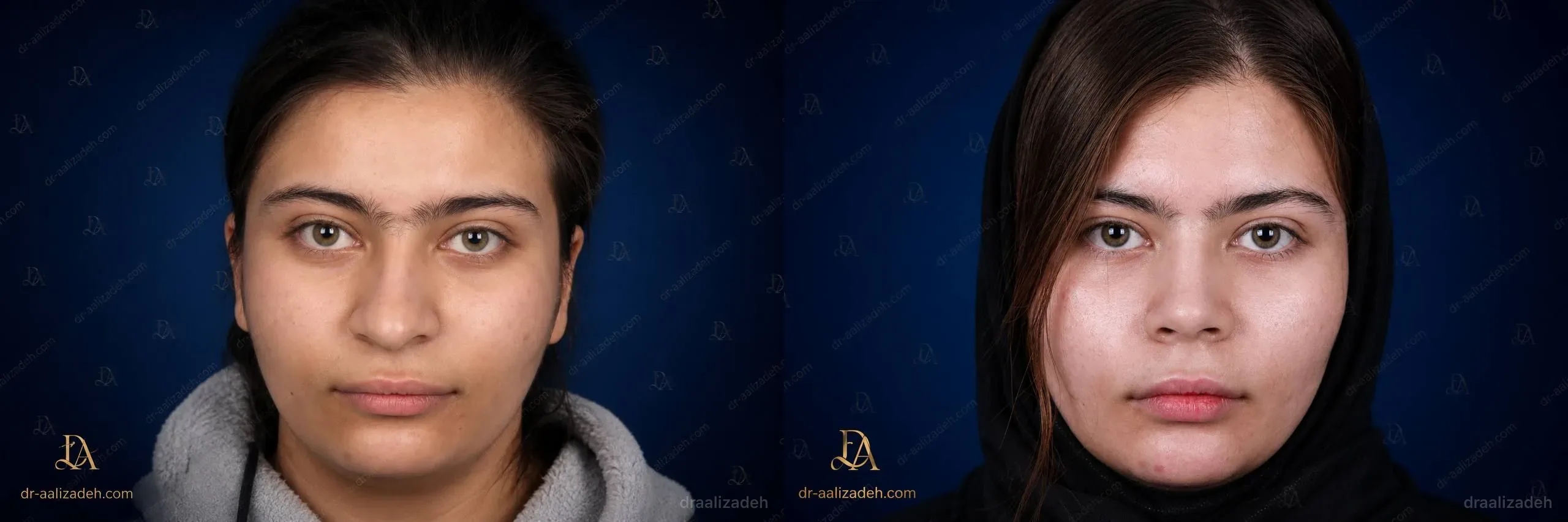 Provider-published rhinoplasty comparison image 4 from Dr. Ali Alizadeh