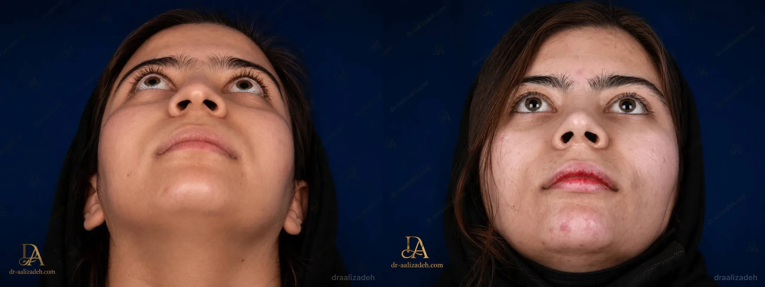 Provider-published rhinoplasty comparison image 5 from Dr. Ali Alizadeh