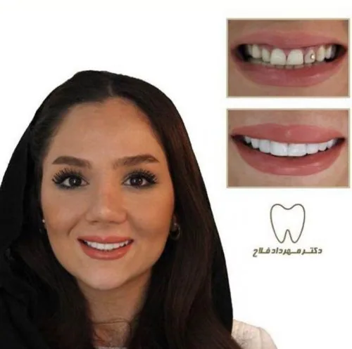 Provider-published dental treatment comparison from Dr. Mehrdad Fallah Clinic, example 2