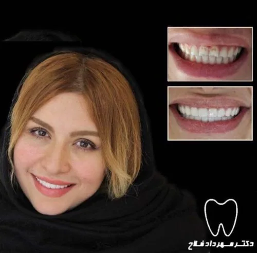 Provider-published dental treatment comparison from Dr. Mehrdad Fallah Clinic, example 4