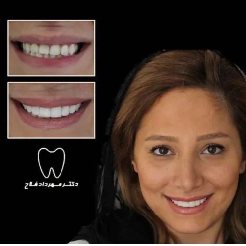 Provider-published dental treatment comparison from Dr. Mehrdad Fallah Clinic, example 5