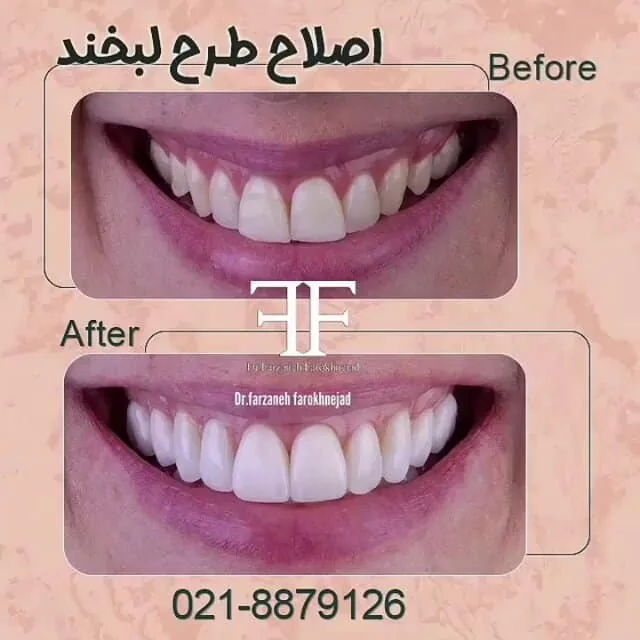 Provider-published dental treatment comparison from Dr. Farzaneh Farokhnejad Clinic, example 1